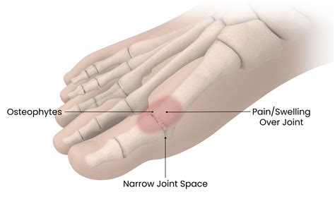 Biopro Hemi Toe Implant For Hallux Rigidus