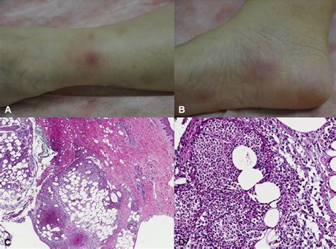 Subcutaneous Sweet Syndrome A And B Multiple Deep Painful And