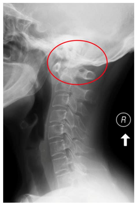 An X-ray of the cervical spine (lateral view) of a 65-year-old female ...