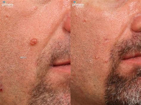 Cyst Removal Before And After Photo Gallery Orlando Florida Primera Plastic Surgery