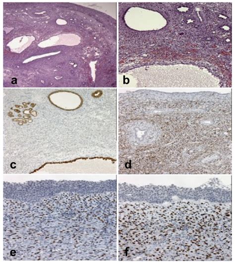 Low Magnification Shows A Tumour Composed Of Large Cysts As Well As