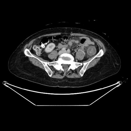 Nonocclusive Ischemic Colitis Image Radiopaedia Org