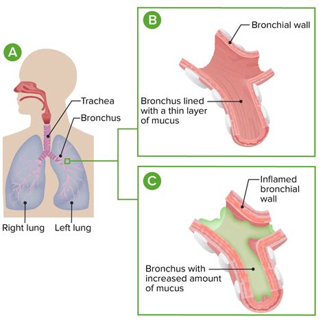 Rsv Fluid In Lungs | smartblastme.com