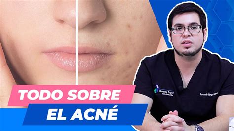 Hablemos De Acné Con El Dr Fernando Vásquez Lapel Youtube