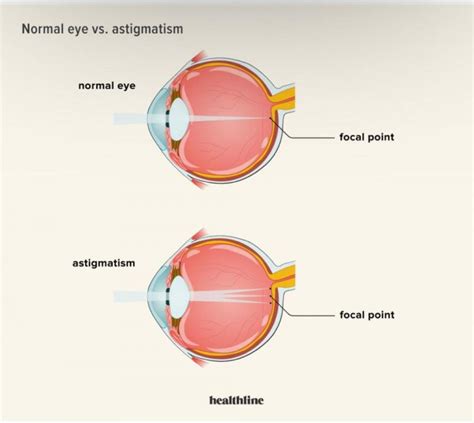 What Is Astigmatism Cypress Eye Centre