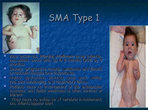 Spinal Muscular Atrophy Sma By Allelieh