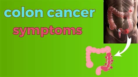 Colon Cancer Symptoms And Work Up Youtube