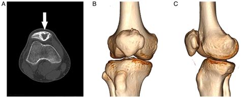 Osteoblastoma Of The Patella A Rare Benign Bone Tumor With An Uncommon