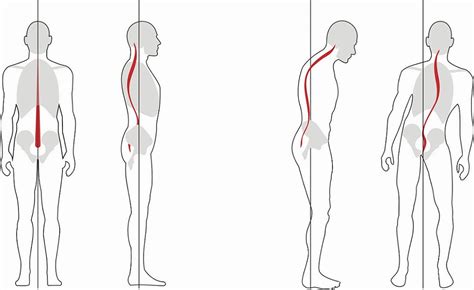 Scoliosis - Adult Degenerative Deformity - Sydney Neurospine