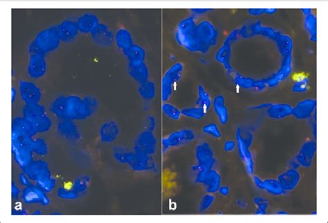 Fish Break Apart Assay For Tmprss Erg A Carcinoma Expressing P