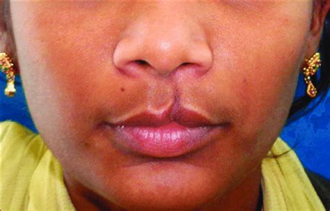 Case 1 Unilateral Incomplete Cleft Lip Of Left Side Download