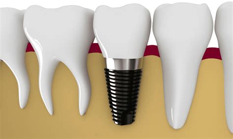 Why Is Dental Implant Maintenance So Important Complete Dental Arts