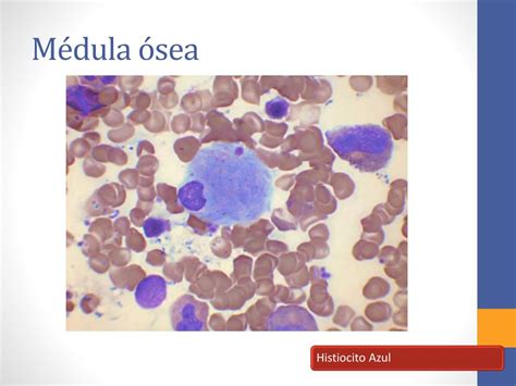 Ppt Leucemia Mieloide Crónica Powerpoint Presentation Free Download Id6961146