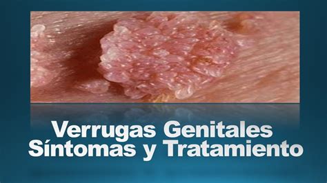 Causas De Las Verrugas Genitales Con Que Se Cura Las Verrugas Images