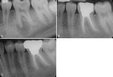 Evaluation Of Outcomes Pocket Dentistry