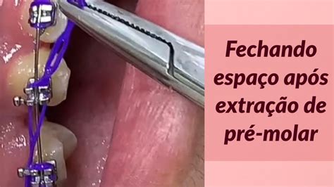 Fechando Espa O Ap S Extra O De Dente Pr Molar Youtube