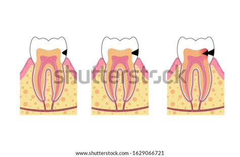 Vector Isolated Illustration Tooth Caries Stages Stock Vector Royalty