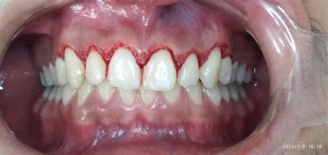 Gingivectom A Est Tica O Gingivoplastia