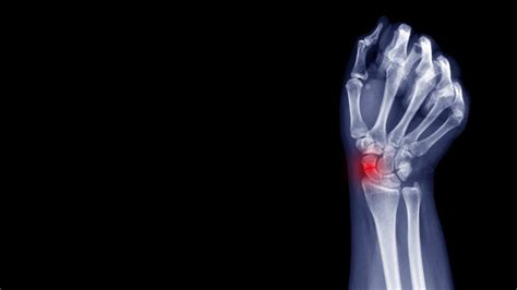 Types Of Hand And Wrist Fractures Ladan Hajipour