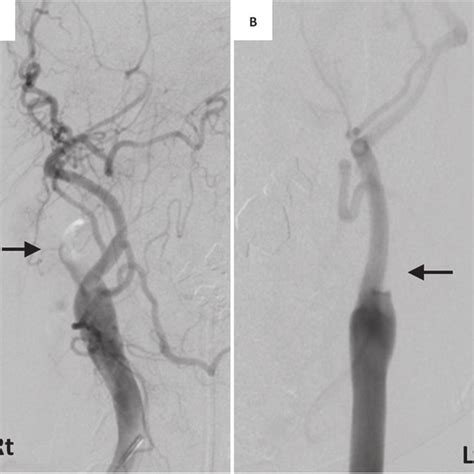 Pdf A Case Of Acute Simultaneous Bilateral Internal Carotid Artery