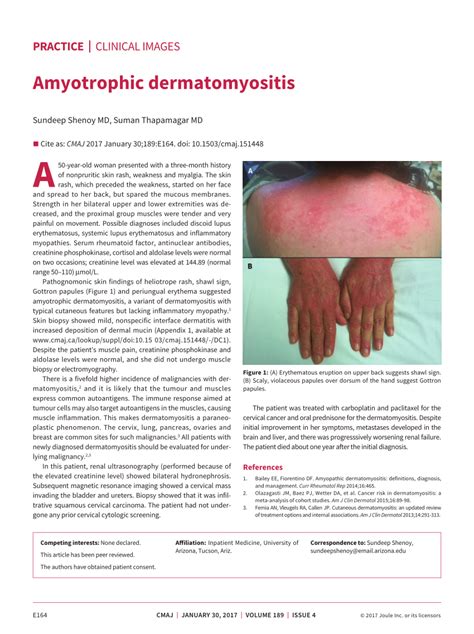 PDF Amyotrophic Dermatomyositis