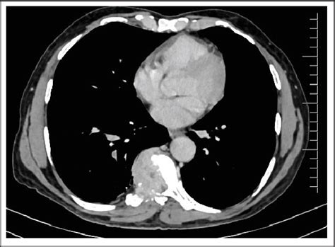 Hepatocellular Carcinoma With A Floating Right Atrial Thrombus And