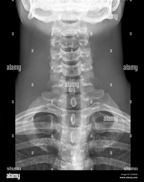 Healthy Cervical Spine Xray