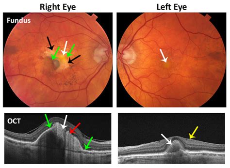 Adult Vitelliform Lesions The Retina Reference