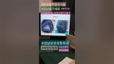 Shorts탈모탈모시술여성탈모남성탈모리제네라엠박영진헤어포뮬라모낭줄기세포탈모치료비수술치료탈모약비오틴탈모치료