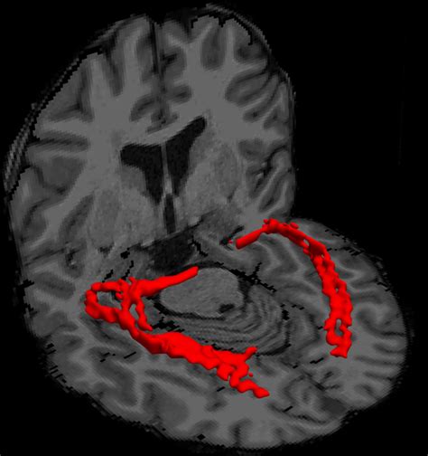 Volume Rendered Results Of The Thresholded Tractography Results Of The Download Scientific