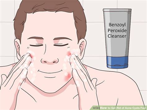 4 Ways To Get Rid Of Acne Cysts Fast Wikihow