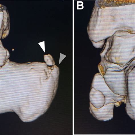 Preoperative Threedimensional Computed Tomography Images Of The Right