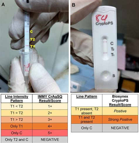 Evaluation Of Serum Cryptococcal Antigen Testing Using Two Novel Semiquantitative Lateral Flow