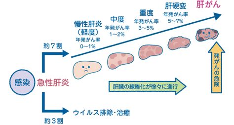 C型肝炎について 木村医院