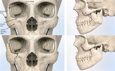 Cheekbone Fracture Zygoma Treatment Options