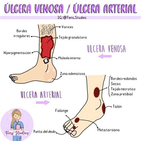 Resúmenes de Úlceras arteriales Descarga apuntes de Úlceras arteriales