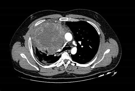 Teratoma (patient information) - wikidoc