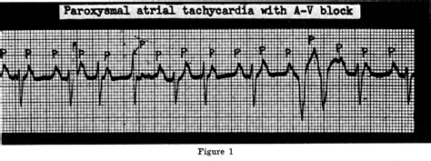 Paroxysmal Atrial Tachycardia