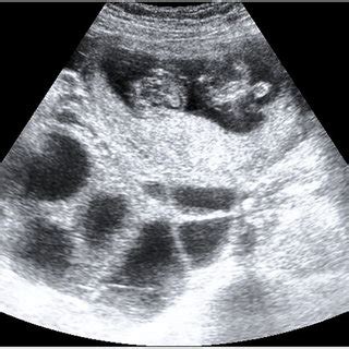 Ultrasound: ultrasonography showed dichorionic-diamniotic gestation and ...