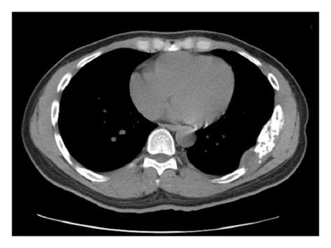 A Axial Ct Chest Without Contrast And Soft Tissue Views Demonstrating