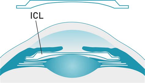 ICL Artificial Lens Implantation Vision Improvement For Thin Corneas