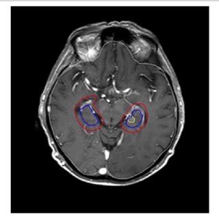 Contrast Enhanced Axial T1 Magnetic Resonance Imaging MRI Of A