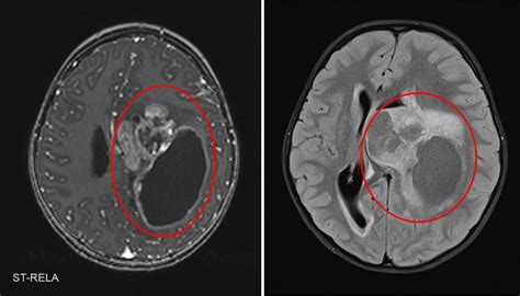 Ependymoma Pediatric Brain Tumor Portal