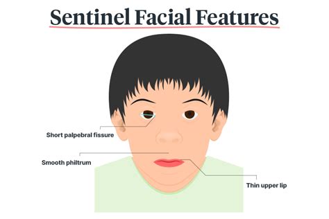 Fetal Alcohol Spectrum Disorder Fasd Ausmed