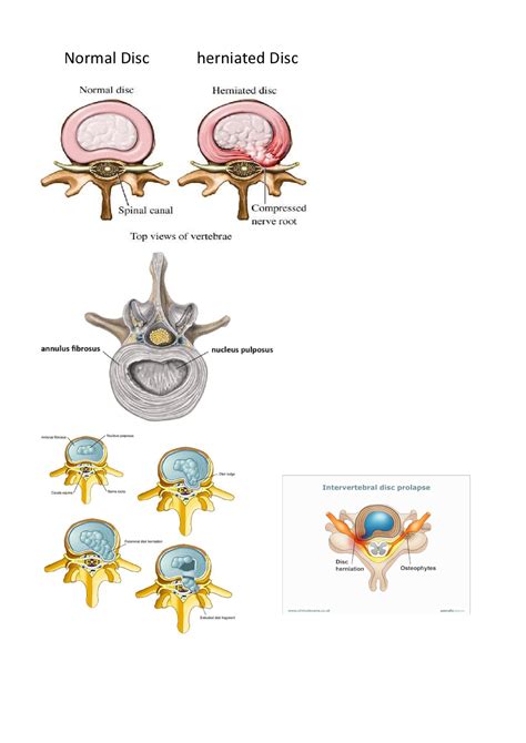 Prolapsed Intervertebral Disc Prolapsed Intervertebral Disc The Term