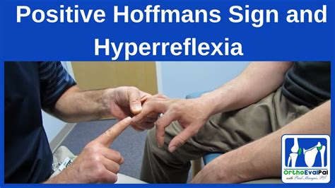 Positive Hoffmans Sign and Hyperreflexia - YouTube