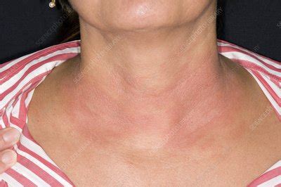 Eczema on the neck - Stock Image - C008/5600 - Science Photo Library