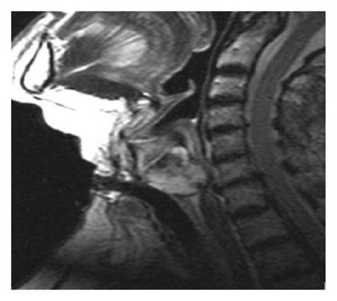 T Weighted Turbo Spin Echo Sagittal Image Shows A Lobulated High