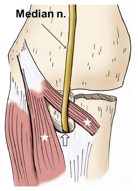 Pronator Teres Median Nerve Entrapment