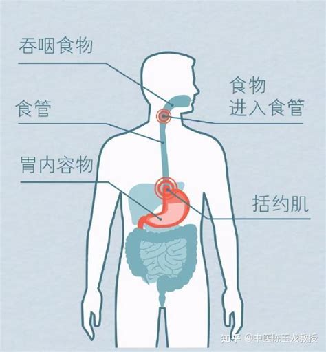 烧心反酸 胃嘈杂不适？胃食管反流 中医调治有妙方，对症治疗很有效 知乎